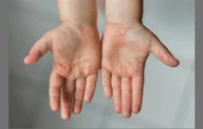 হামের উপসর্গে আরও দুই শিশুর মৃ’ত্যু, একজন মৌলভীবাজারের