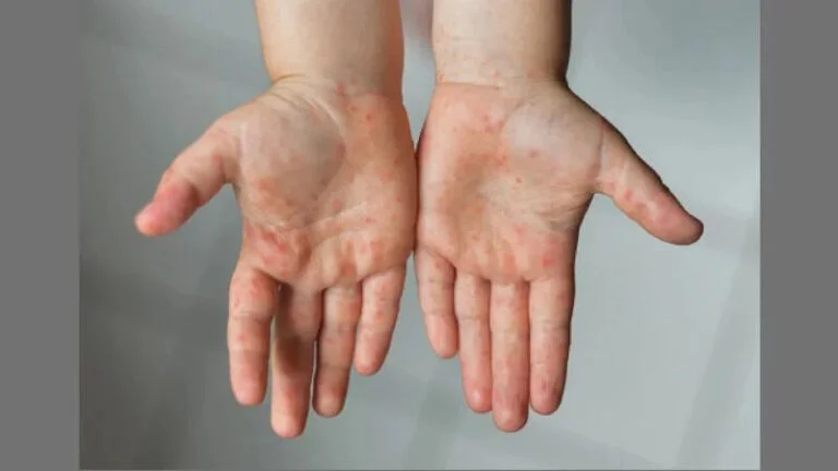 হামের উপসর্গে আরও দুই শিশুর মৃ’ত্যু, একজন মৌলভীবাজারের